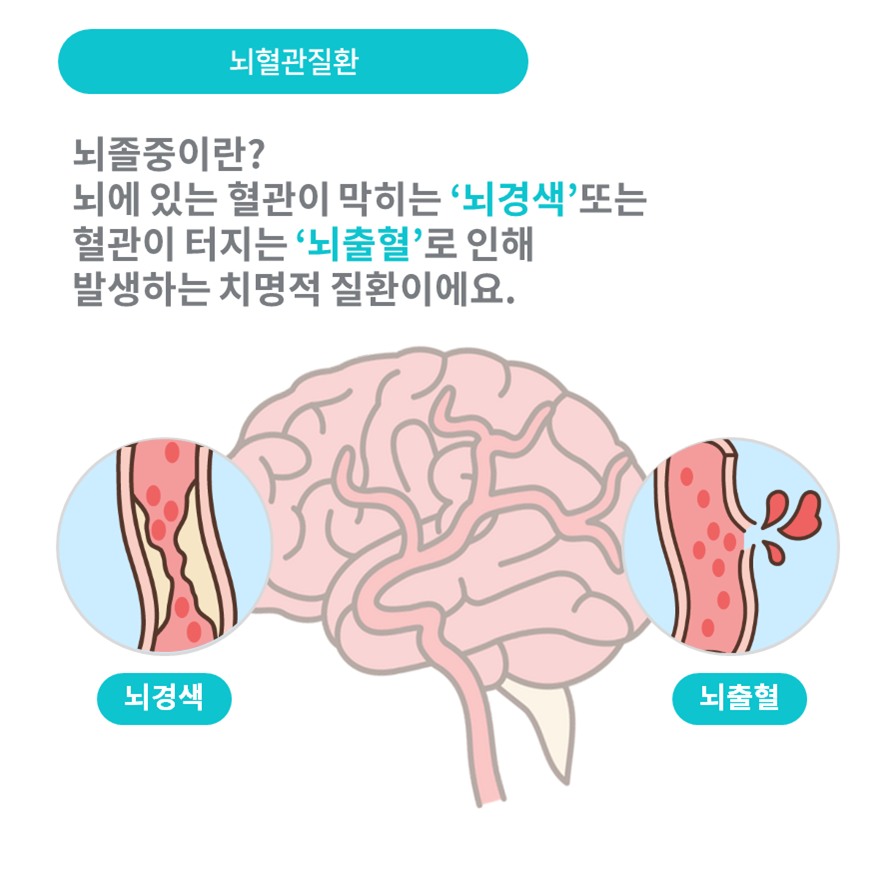 뇌졸중이란? 뇌경색, 뇌출혈로 인해 발생하는 치명적인 질환